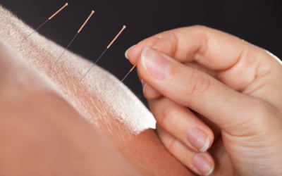 Acupunctuur
